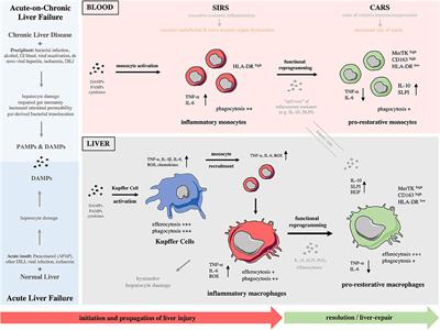 The Role of Monocytes and Macrophages in Acute and Acute-on-Chronic Liver Failure